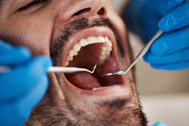 Best Emergency Wisdom Teeth Removal in Itasca, IL